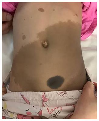Case report: Treatment response of NF-1-associated bladder ganglioneuroma to trametinib